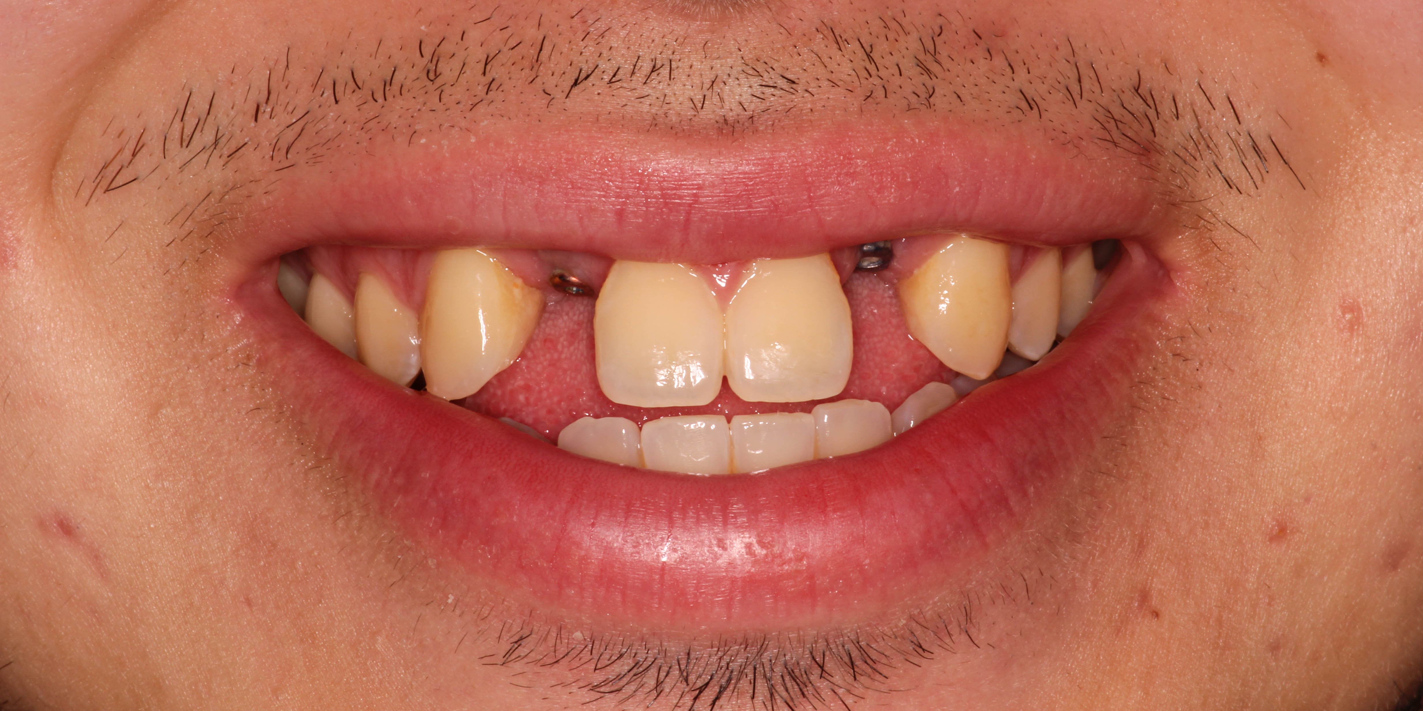 Before: smiling with missing upper front teeth