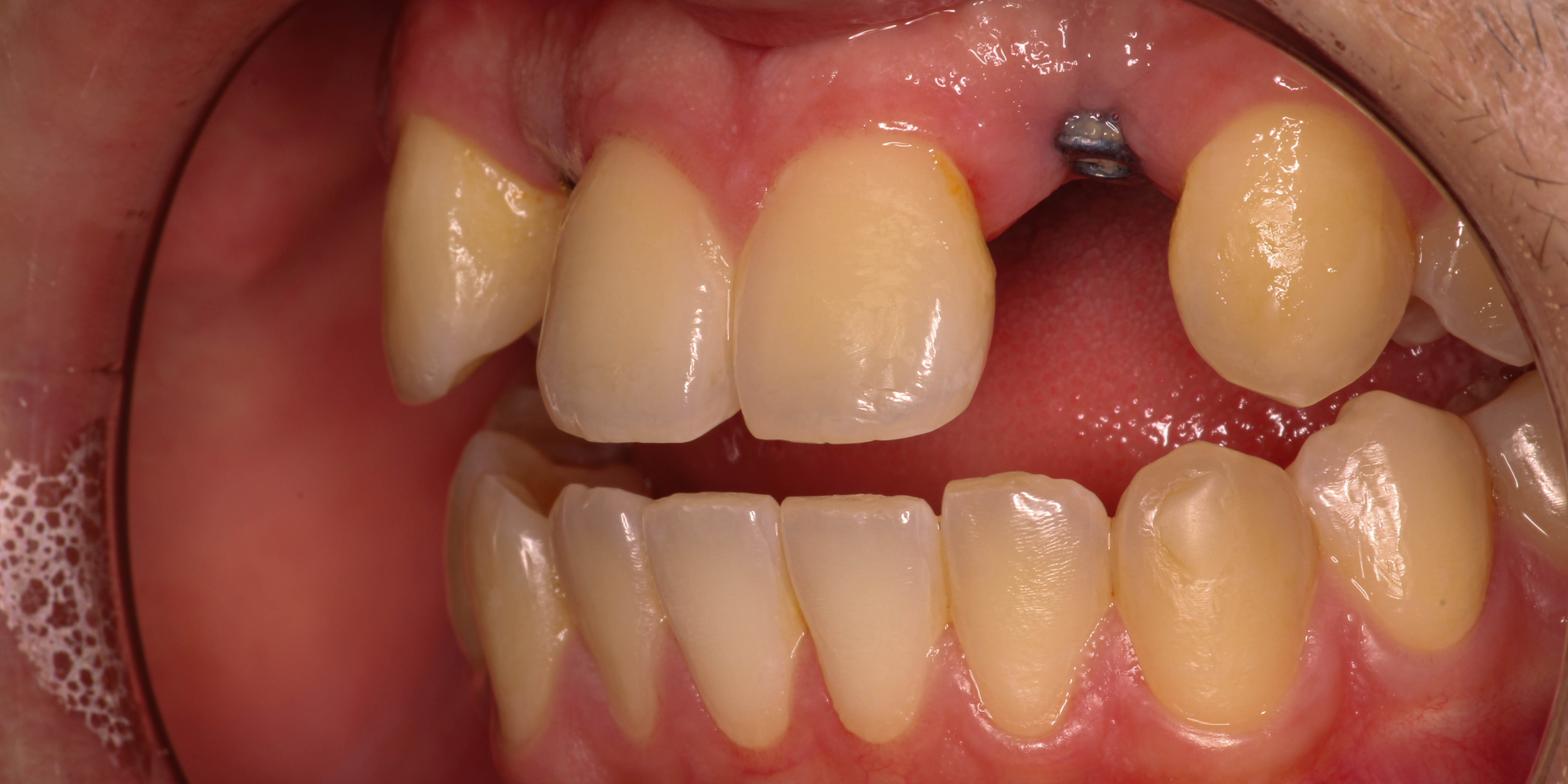 Before: close-up of missing front teeth