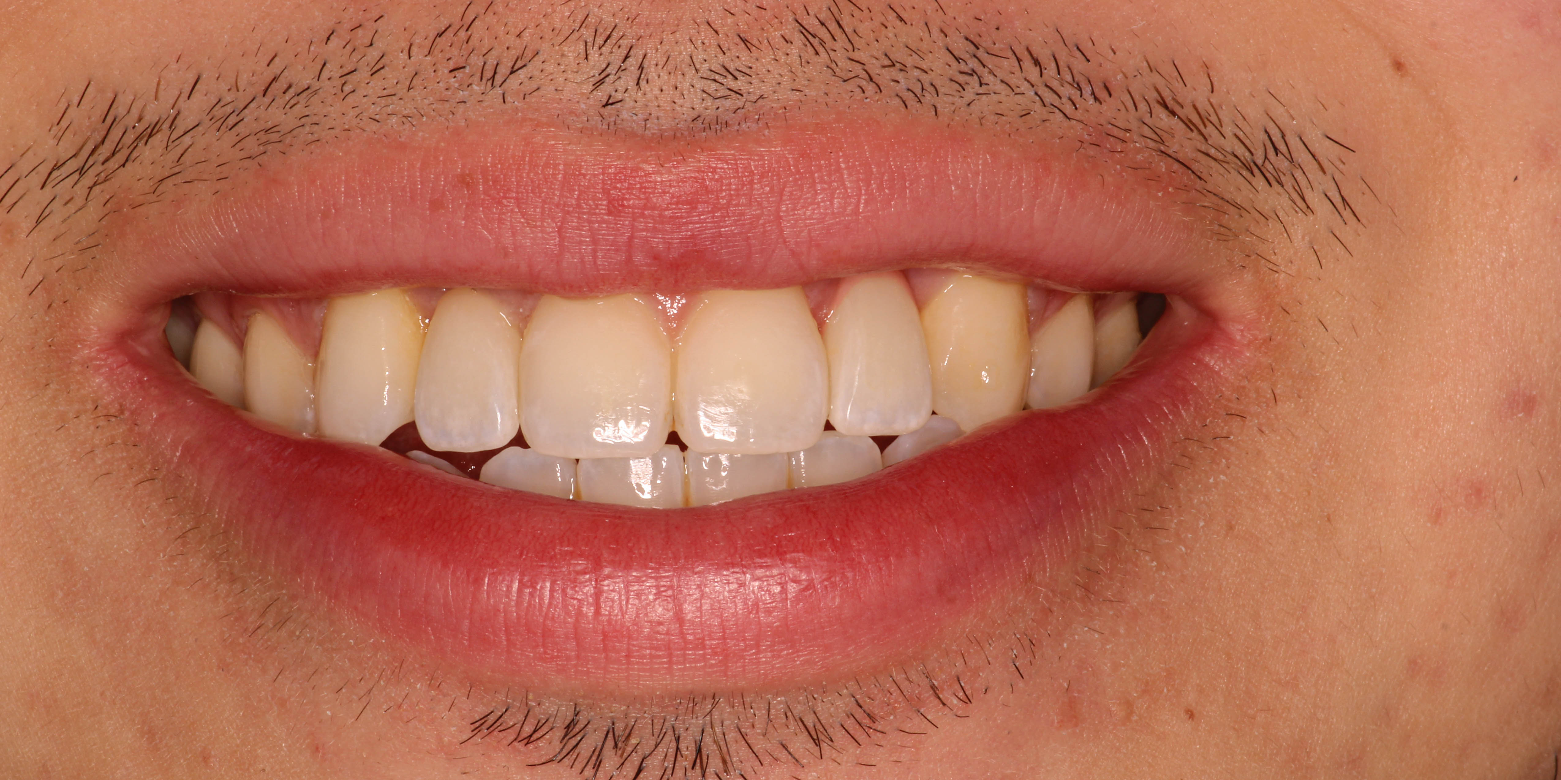 After: restored smile with implant crowns