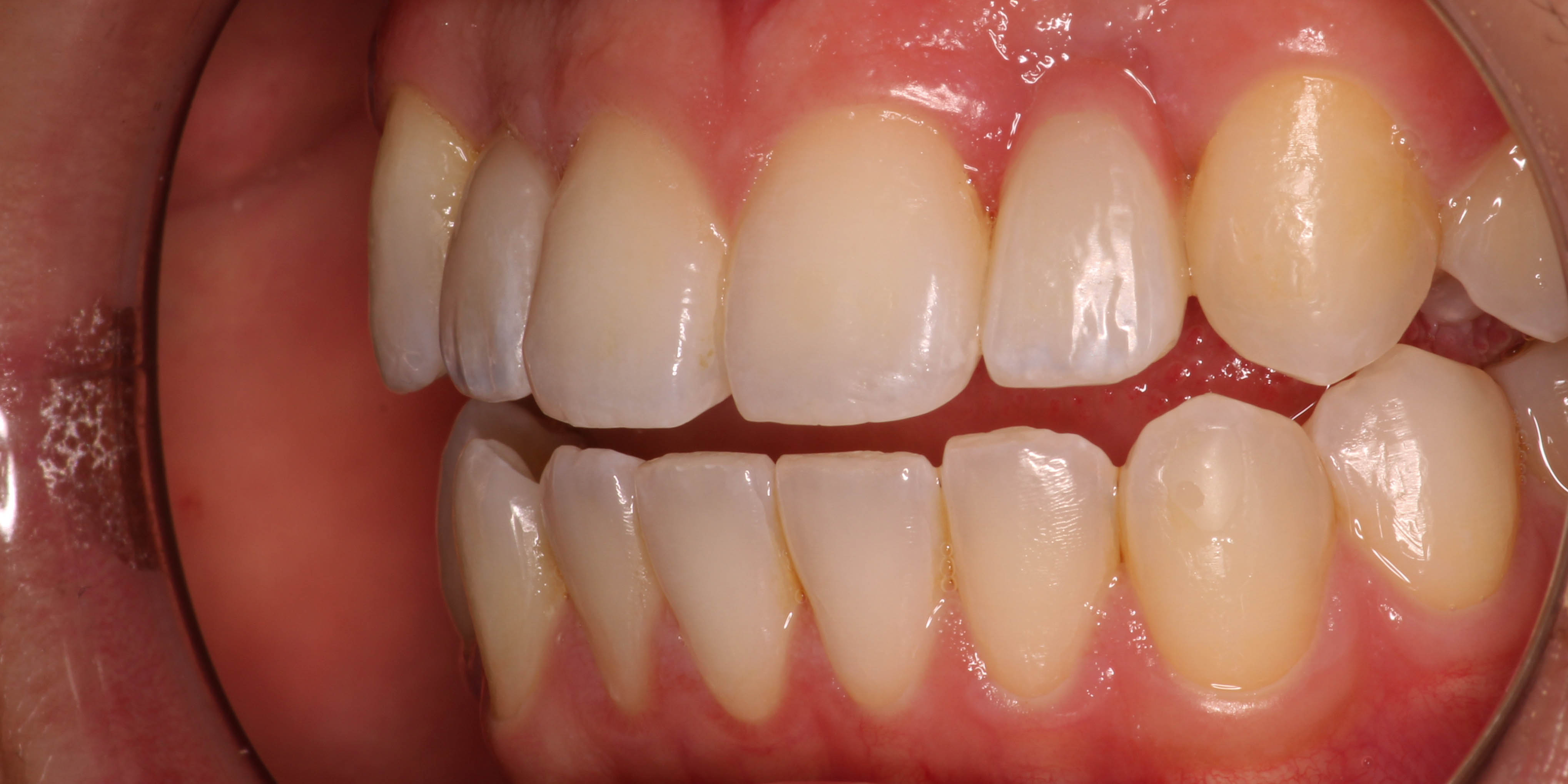 After: close-up of finished implant crowns